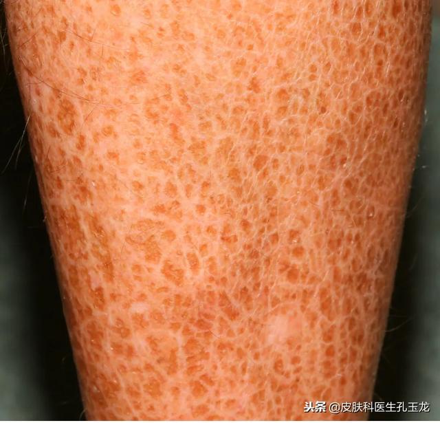 腿上有鱼鳞一样怎么回事 腿上有鱼鳞一样怎么回事