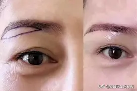医生同你聊一聊：关于“提眉手术”，大多数人会问的几件事图片