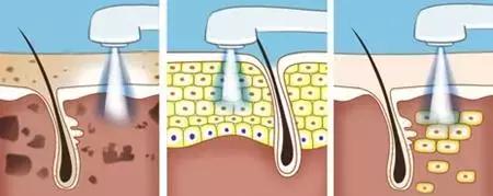 空心斑是汗孔角化症吗