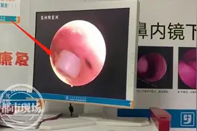 南昌一9岁男童，耳朵里塞进软胶！医生：塞异物可能是疾病的征兆图片