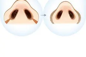 单纯缩鼻翼对鼻子的改善大么？图片