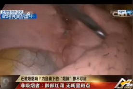 内窥镜下的“烟肺”，你见过吗？戒烟后，肺部还能恢复健康吗？图片