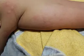 宝宝身上起好多疙瘩，跟蚊子咬的差不多，很痒，怎么办亲身经历图片