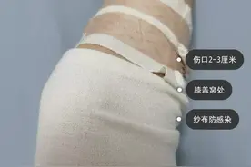 2亿人围观的“瘦腿手术”有多危险？图片