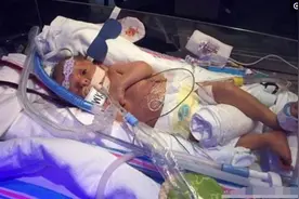 双胞胎哥哥在弟弟离世前紧紧抱住他，看了让人心酸图片