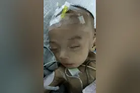 拯救超短肠男婴！小肠坏死仅剩8厘米！母亲患精神疾病生父不明图片