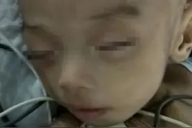 拯救超短肠男婴！小肠坏死仅剩8厘米！母亲患精神疾病生父不明图片