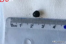 65岁男子嗓子咳嗽刺挠三个月，脑袋憋得疼！提醒：这种“嗓子疼”要当心！图片