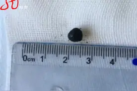 65岁男子嗓子咳嗽刺挠三个月，脑袋憋得疼！提醒：这种“嗓子疼”要当心！图片