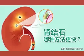 肾结石最快的排石方法，看完自己就会选图片