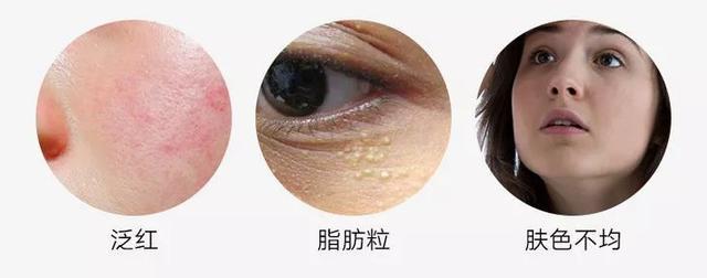 去粉刺毛囊炎痤疮鸡皮身体乳