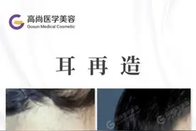 小耳畸形怎么办？耳再造专家余文林解答图片
