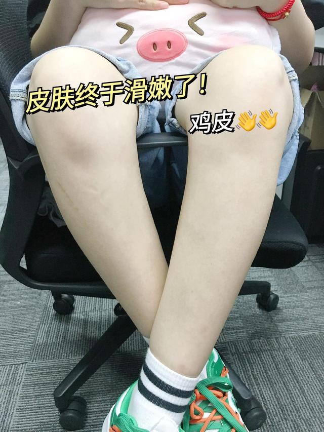 尿素霜能去鸡皮疙瘩吗