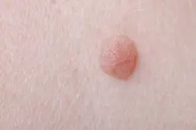 皮肤长了肉疙瘩，不痛不痒，或暗示了4个毛病，及早检查更安心图片