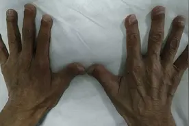 得了尿毒症，一直透析能活多少年？寿命能延续多久，取决于这4点图片