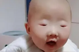 宝宝长成“豆豆眼”，宝妈担心有问题，医生：非常健康，除小点图片