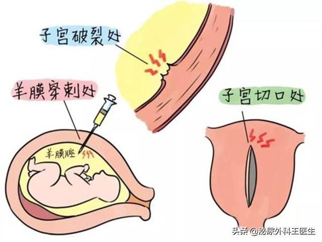 卵巢全切后怎样过好夫妻生活,子宫切除后还能进行性生活吗,妇科医生为