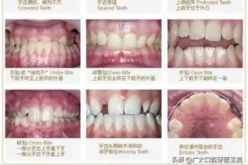 想要牙齿矫正，选择医生有技巧，具备这4个条件才可以矫正图片