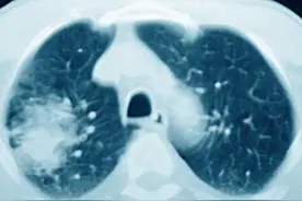 两位肺癌晚期患者的痛苦历程，千金散尽后，无奈谢幕图片