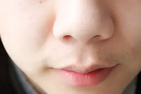 鼻子两侧能挤出来白色颗粒物，是什么？图片