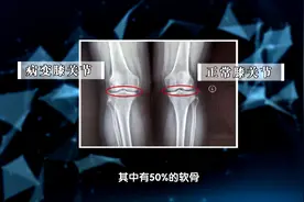 50岁后，八成人软骨被磨掉一半！专家一招，教你护关节，养膝盖图片