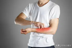 什么是疥疮？图片