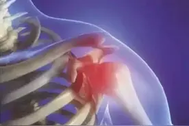 肩峰撞击综合症到底是什么呢？图片