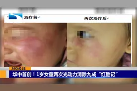 华中首创！1岁女童两次光动力清除九成“红胎记”视频封面