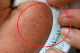 妈妈发现宝宝身上有“黑头”，耐心地全部拔掉，医生：太无知了图片