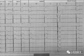 今天要分享的心电图图片