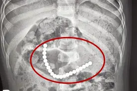 危险!合肥2岁男童误吞21颗巴克球磁珠 开腹才取出图片