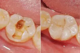 补牙“油水”有多大？补牙前，请一字不漏地看完图片