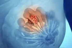 什么是乳腺穿刺活检？痛吗？你想要的答案在这里图片