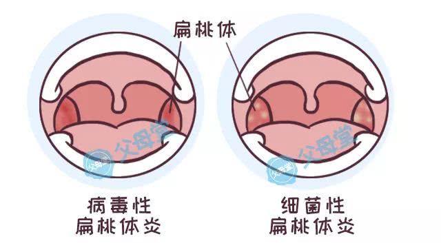 儿童扁桃体角化自愈