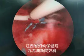 “曼月乐环”反复脱落怎么办？妇科医生一招帮您解决“熊孩子”困扰图片