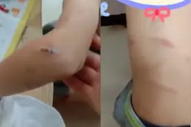 云南7岁男孩被继母用衣架抽伤，亲妈报警，父亲：再犯就离婚告她视频封面