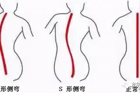脊柱侧凸常见问题图片