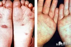 【宝妈宝爸看过来】宝宝手脚长了红点点，是不是手足口病？图片