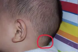 小孩颈部淋巴结肿大：是什么原因？如何治疗？医生带你了解一下图片