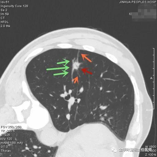 叶建明谈结节：检查发现肺实性结节怎么办？个人版实用指南
