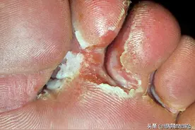 治疗脚气的药除了达克宁，您还知道什么图片