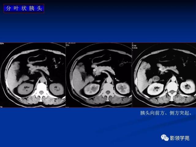 胰腺的解剖与常见变异