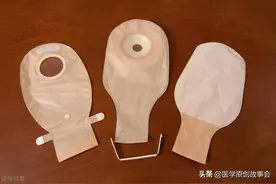 一个人没了肛门会怎样？我国“造口人”超百万，但痛苦无人能懂图片