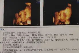 今天去医院四维了。图片