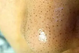 日常坚持做这3件事，甩掉密密麻麻的黑头，毛孔变小皮肤更细腻图片