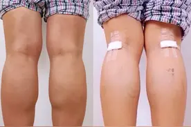“神经阻断瘦腿”人为制造残疾！七大“医美邪术”谁来管？图片
