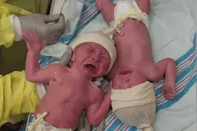 史上“最相爱”双胞胎，分开超1厘米就大哭不止，网友：太治愈了图片