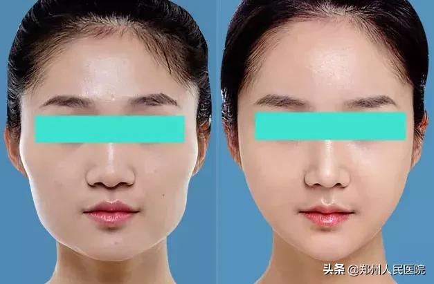 颧骨突出的脸型图,颧骨高很容易变"菱形脸"刻薄还显老 - 趣测网