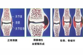 八旬阿婆双手疼痛彻夜难眠，原来竟是它在作怪图片
