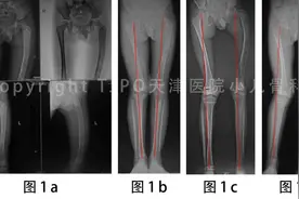 病例分享｜纤维异样增殖症股骨近端牧羊拐畸形的矫正图片